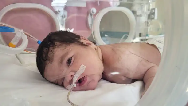 Dünyada Eşine Az Rastlanan Durum: 34 Haftalık Eymen Bebeğin Kurtuluş Hikayesi